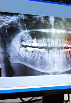 Dental x-rays on monitor