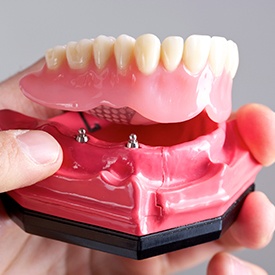 Model of implant retained denture