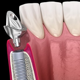 A 3D illustration of a placed dental implant and its abutment