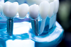 Close-up of dental implants in a plastic tray